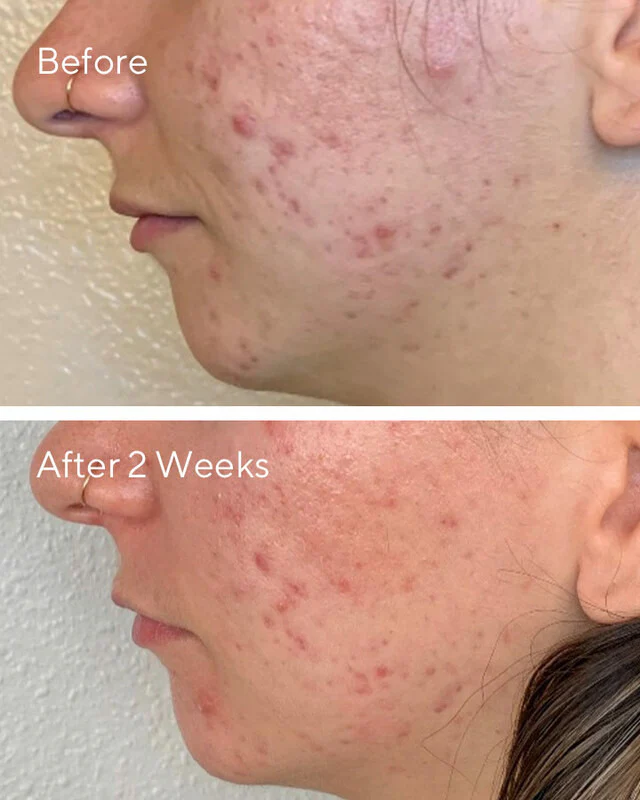 AHA/BHA/Retinoid Daily Clarifying Peel - Image 5