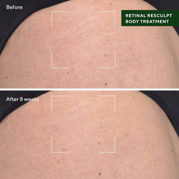 Retinal ReSculpt Body Treatment - Image 8
